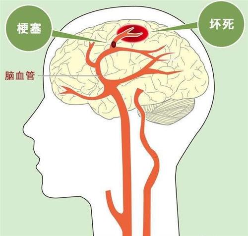 脑血栓脑梗死的自然疗法技术原理