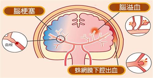 脑卒中防治知识